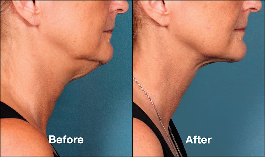 kybella before and after